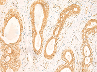 Immunohistochemistry of paraffin-embedded Human breast cancer tissue using ST8SIA4 Polyclonal Antibody at dilution of 1:50 (×200)