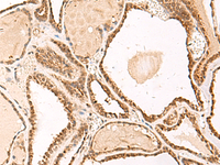 Immunohistochemistry of paraffin-embedded Human thyroid cancer tissue using FUNDC2 Polyclonal Antibody at dilution of 1:50 (×200)