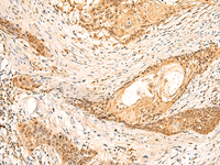 Immunohistochemistry of paraffin-embedded Human esophagus cancer tissue using EEF1AKMT2 Polyclonal Antibody at dilution of 1:50 (×200)