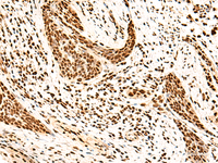 Immunohistochemistry of paraffin-embedded Human esophagus cancer tissue using SNRPB2 Polyclonal Antibody at dilution of 1:75 (×200)