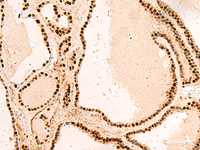 Immunohistochemistry of paraffin-embedded Human thyroid cancer tissue using SNRPB2 Polyclonal Antibody at dilution of 1:75 (×200)