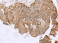 Immunohistochemistry of paraffin-embedded Human colorectal cancer tissue using HCCS Polyclonal Antibody at dilution of 1:110 (×200)