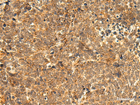 Immunohistochemistry of paraffin-embedded Human lung cancer tissue using ABHD10 Polyclonal Antibody at dilution of 1:50 (×200)