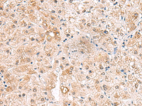 Immunohistochemistry of paraffin-embedded Human liver cancer tissue using RTKN2 Polyclonal Antibody at dilution of 1:75 (×200)