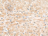 Immunohistochemistry of paraffin-embedded Human liver cancer tissue using LRG1 Polyclonal Antibody at dilution of 1:50 (×200)
