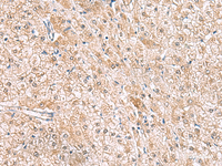 Immunohistochemistry of paraffin-embedded Human liver cancer tissue using HLA-E Polyclonal Antibody at dilution of 1:50 (×200)