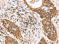 Immunohistochemistry of paraffin-embedded Human esophagus cancer tissue using GABPB1 Polyclonal Antibody at dilution of 1:70 (×200)