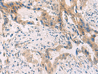Immunohistochemistry of paraffin-embedded Human cervical cancer tissue using PCYT2 Polyclonal Antibody at dilution of 1:55 (×200)