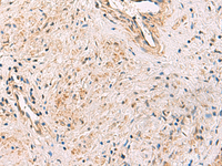 Immunohistochemistry of paraffin-embedded Human prost ate cancer tissue using PCYT2 Polyclonal Antibody at dilution of 1:55 (×200)