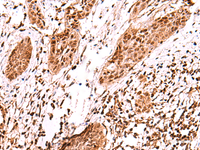 Immunohistochemistry of paraffin-embedded Human esophagus cancer tissue using AK9 Polyclonal Antibody at dilution of 1:60 (×200)