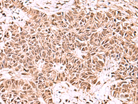 Immunohistochemistry of paraffin-embedded Human ovarian cancer tissue using ACTL6B Polyclonal Antibody at dilution of 1:100 (×200)