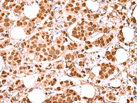 Immunohistochemistry of paraffin-embedded Human breast cancer tissue using RCOR3 Polyclonal Antibody at dilution of 1:60 (×200)