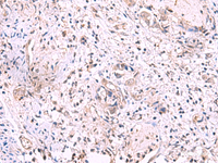 Immunohistochemistry of paraffin-embedded Human cervical cancer tissue using KIR3DL1 Polyclonal Antibody at dilution of 1:95 (×200)