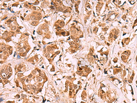 Immunohistochemistry of paraffin-embedded Human breast cancer tissue using RRP8 Polyclonal Antibody at dilution of 1:80 (×200)