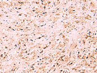 Immunohistochemistry of paraffin-embedded Human prost at e cancer tissue using ZSWIM1 Polyclonal Antibody at dilution of 1:95 (×200)