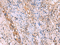 Immunohistochemistry of paraffin-embedded Human cervical cancer tissue using GALK2 Polyclonal Antibody at dilution of 1:95 (×200)