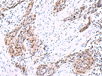 Immunohistochemistry of paraffin-embedded Human esophagus cancer tissue using POLD2 Polyclonal Antibody at dilution of 1:95 (×200)