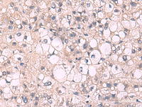 Immunohistochemistry of paraffin-embedded Human liver cancer tissue using KPNA2 Polyclonal Antibody at dilution of 1:85 (×200)