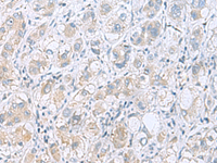 Immunohistochemistry of paraffin-embedded Human liver cancer tissue using GPCPD1 Polyclonal Antibody at dilution of 1:55 (×200)