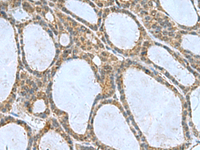 Immunohistochemistry of paraffin-embedded Human thyroid cancer tissue using CNTN4 Polyclonal Antibody at dilution of 1:65 (×200)