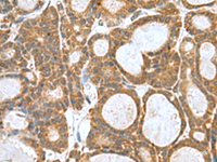 Immunohistochemistry of paraffin-embedded Human thyroid cancer tissue using KANSL1L Polyclonal Antibody at dilution of 1:80 (×200)