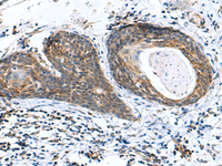 Immunohistochemistry of paraffin-embedded Human esophagus cancer tissue using AP1S3 Polyclonal Antibody at dilution of 1:70 (×200)
