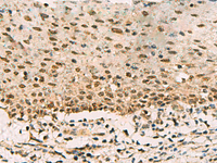 Immunohistochemistry of paraffin-embedded Human cervical cancer tissue using PHF5A Polyclonal Antibody at dilution of 1:90 (×200)