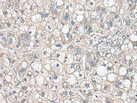 Immunohistochemistry of paraffin-embedded Human liver cancer tissue using RHBDL2 Polyclonal Antibody at dilution of 1:110 (×200)