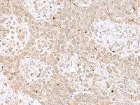 Immunohistochemistry of paraffin-embedded Human ovarian cancer tissue using RPL35 Polyclonal Antibody at dilution of 1:70 (×200)