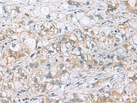 Immunohistochemistry of paraffin-embedded Human liver cancer tissue using PHPT1 Polyclonal Antibody at dilution of 1:210 (×200)