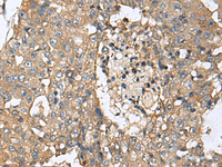 Immunohistochemistry of paraffin-embedded Human liver cancer tissue using CD59 Polyclonal Antibody at dilution of 1:160 (×200)
