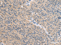 Immunohistochemistry of paraffin-embedded Human cervical cancer tissue using FAM19A4 Polyclonal Antibody at dilution of 1:55 (×200)