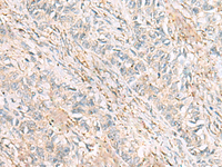 Immunohistochemistry of paraffin-embedded Human ovarian cancer tissue using HBZ Polyclonal Antibody at dilution of 1:120 (×200)