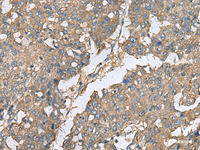 Immunohistochemistry of paraffin-embedded Human liver cancer tissue using EIF1AX Polyclonal Antibody at dilution of 1:65 (×200)