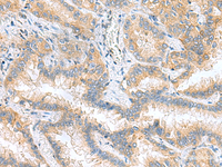 Immunohistochemistry of paraffin-embedded Human lung cancer tissue using RPS16 Polyclonal Antibody at dilution of 1:60 (×200)