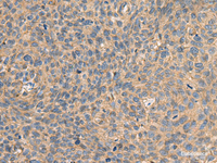 Immunohistochemistry of paraffin-embedded Human cervical cancer tissue using AHNAK Polyclonal Antibody at dilution of 1:50 (×200)