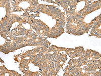 Immunohistochemistry of paraffin-embedded Human colorectal cancer tissue using AHNAK Polyclonal Antibody at dilution of 1:50 (×200)