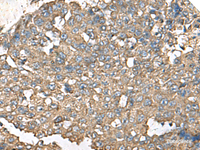 Immunohistochemistry of paraffin-embedded Human liver cancer tissue using RPS14 Polyclonal Antibody at dilution of 1:50 (×200)