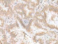 Immunohistochemistry of paraffin-embedded Human lung cancer tissue using CPLX3 Polyclonal Antibody at dilution of 1:55 (×200)