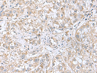 Immunohistochemistry of paraffin-embedded Human liver cancer tissue using CGB5 Polyclonal Antibody at dilution of 1:55 (×200)