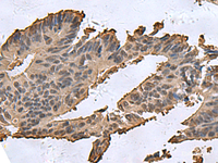 Immunohistochemistry of paraffin-embedded Human colorectal cancer tissue using DCTPP1 Polyclonal Antibody at dilution of 1:85 (×200)