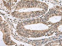 Immunohistochemistry of paraffin-embedded Human colorectal cancer tissue using TMX3 Polyclonal Antibody at dilution of 1:70 (×200)