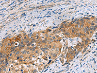 Immunohistochemistry of paraffin-embedded Human cervical cancer tissue using JOSD1 Polyclonal Antibody at dilution of 1:70 (×200)