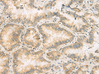 Immunohistochemistry of paraffin-embedded Human lung cancer tissue using RAB13 Polyclonal Antibody at dilution of 1:50 (×200)