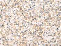 Immunohistochemistry of paraffin-embedded Human liver cancer tissue using PAFAH1B3 Polyclonal Antibody at dilution of 1:70 (×200)