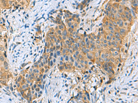 Immunohistochemistry of paraffin-embedded Human cervical cancer tissue using PSMA6 Polyclonal Antibody at dilution of 1:90 (×200)