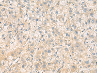 Immunohistochemistry of paraffin-embedded Human liver cancer tissue using PPM1M Polyclonal Antibody at dilution of 1:100 (×200)