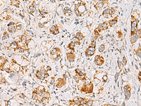 Immunohistochemistry of paraffin-embedded Human liver cancer tissue using MMAB Polyclonal Antibody at dilution of 1:65 (×200)