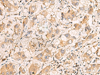 Immunohistochemistry of paraffin-embedded Human liver cancer tissue using TNNT1 Polyclonal Antibody at dilution of 1:75 (×200)