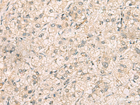 Immunohistochemistry of paraffin-embedded Human liver cancer tissue using TTLL5 Polyclonal Antibody at dilution of 1:70 (×200)
